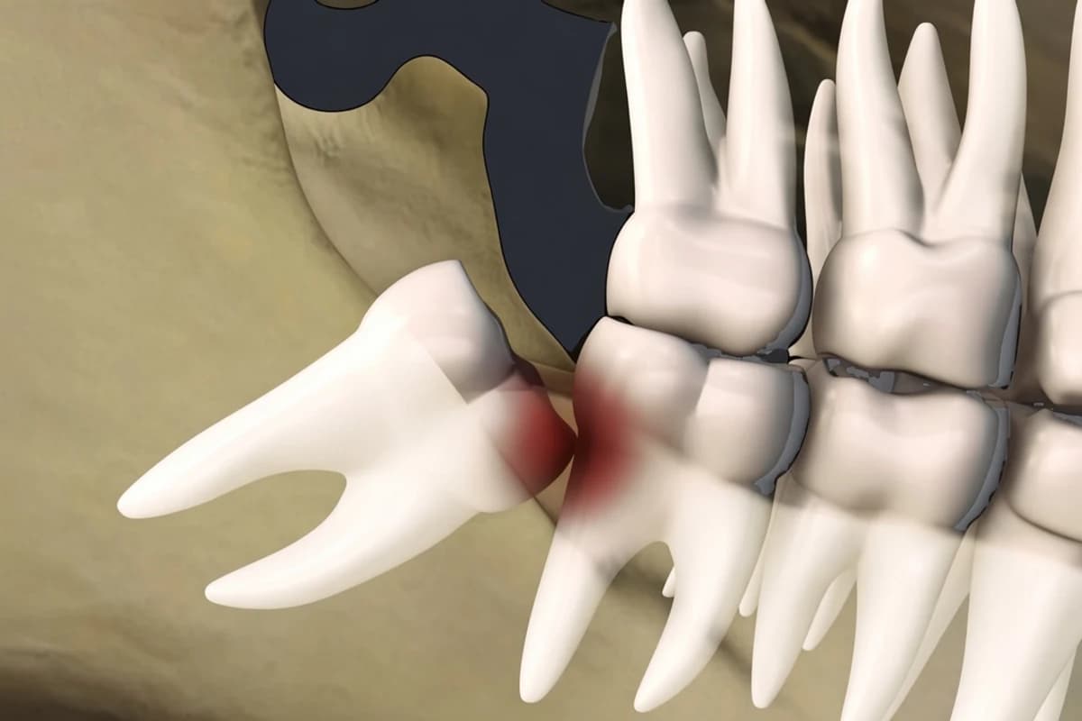 Illustration of a horizontally impacted wisdom tooth pressing on the adjacent molar